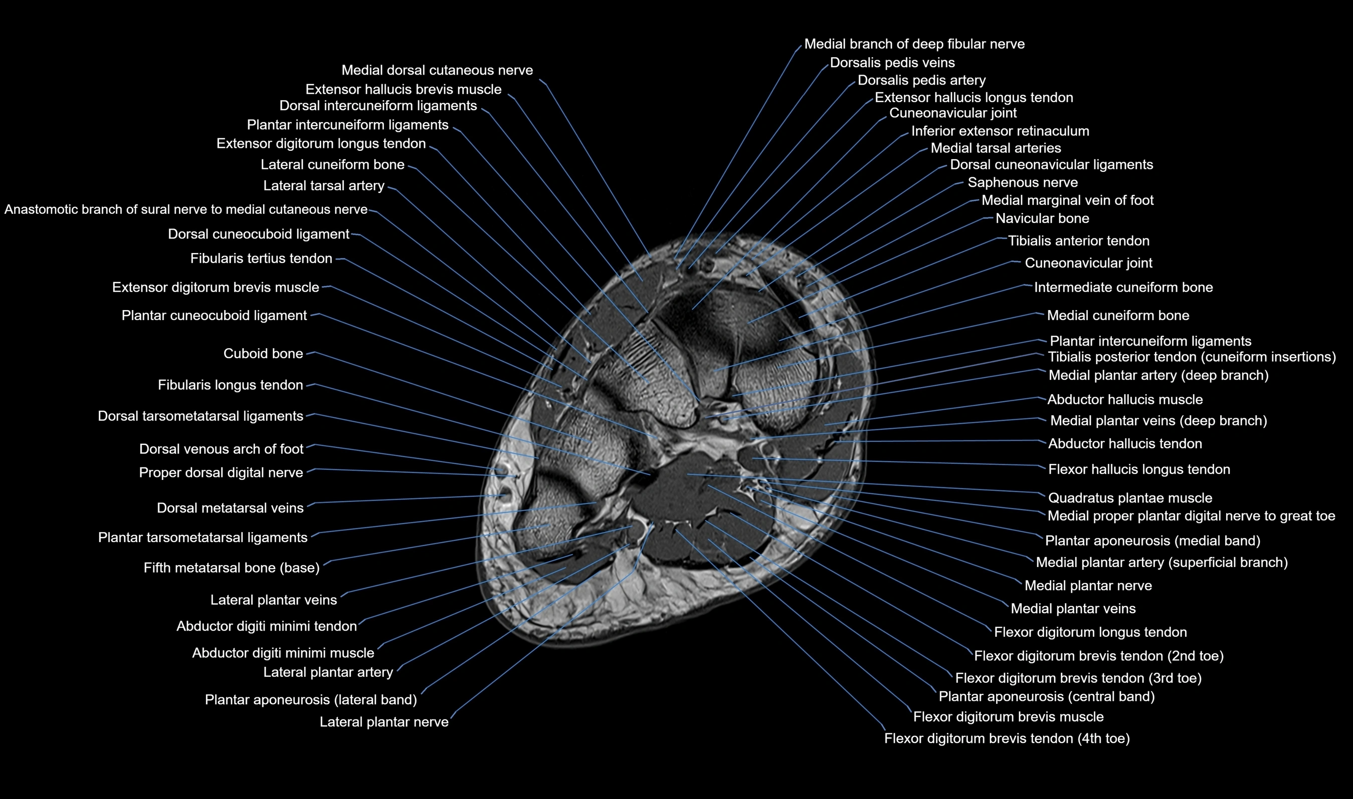 MRI mid foot axial cross sectional anatomy 3T  radiology  image-img-00001-00024.webp